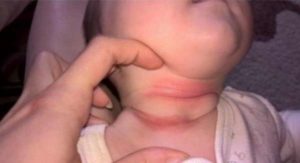 Покраснения половых губ у ребенка