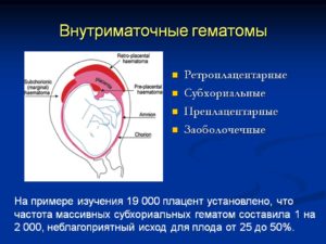 Ретрохориальная гематома. Опасно?