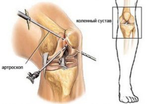 Боль в коленном суставе после артроскопии