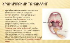 Тонкие белые прожилки на миндалинах у ребенка