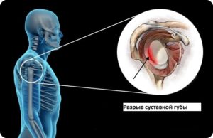 Повреждения передних отделов суставной фиброзно-хрящевой губы гленоида