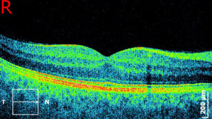 ОСТ макулы и сетчатки