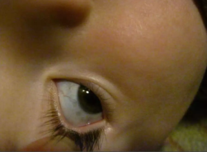 У ребенка на белках глаза серые пятна