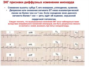 Изменения задне-боковой стенки миокарда неспецифического характера