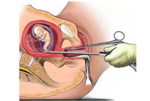 Остатки после мини аборта