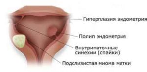 Полип эндометрия, гиперплазия