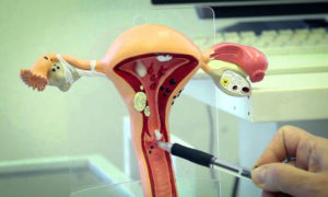 Менструация после биопсии