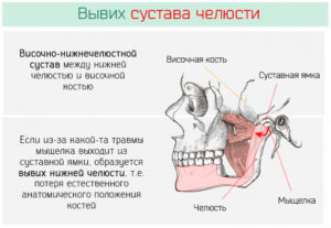 Растяжение связок челюстного сустава