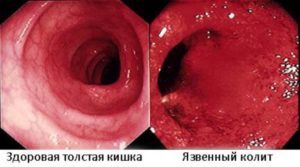 Ложные позывы к дефекации у ребенка