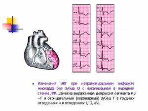 Изменения задне-боковой стенки миокарда неспецифического характера