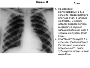 Единичные очаги на правом легком