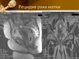 Рак шейки матки рецидив?