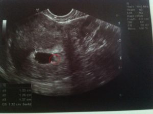 Не видно эмбриона при желточном мешочке 5,7мм