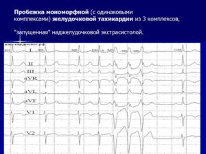 Невроз и экстрасистолы