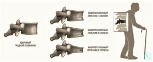 Перелом компрессионный 1-2 степени 12позвонка