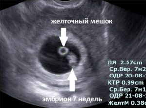 Не видно эмбриона при желточном мешочке 5,7мм