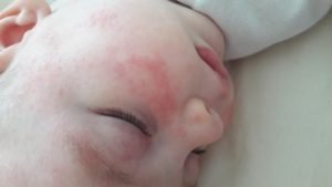 Красные шершавые пятна, мелкие точки на лице у ребенка, помогите