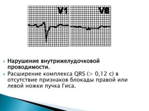 Нарушения желудочковой проводимости у ребенка