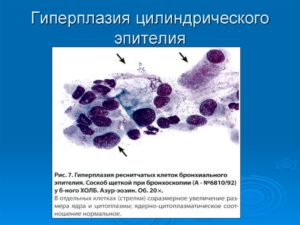 Гиперплазия железистого эпителия
