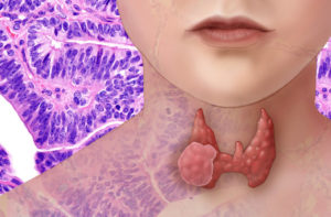 Злокачественный узел на щитовидной железе