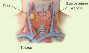 Узлы щитовидной железы