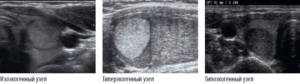 Изоэхогенное образование