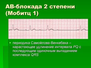 АВ блокада 2 степени