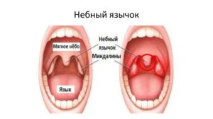 Правая миндалина и небный язычок срослись