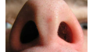 Белые точки на слизистой носа