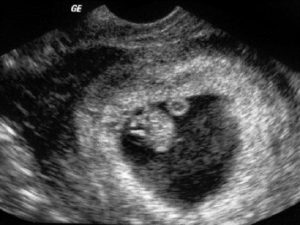 Беременность после анэмбрионии