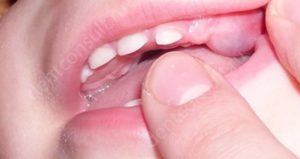 Лимфоузел восполился при прорезывании зуба