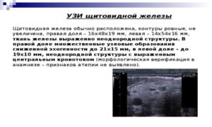 Фокальные изменения в правой доле щитовидной железы