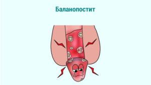 Белые точки под крайней плотью на половом члене у ребенка