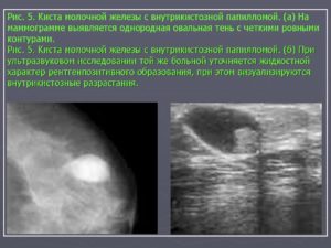 Результаты УЗИ молочной железы, фиброаденома, киста, онкология