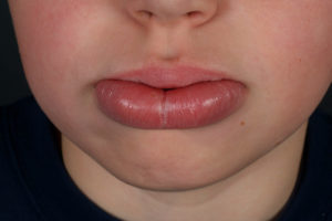 Воспаление верхней губы