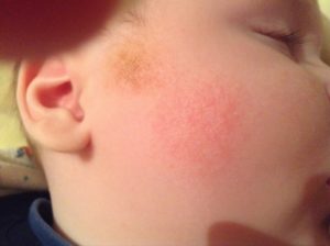 Красные шершавые пятна, мелкие точки на лице у ребенка, помогите
