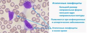 Атипичные лимфоциты в крови