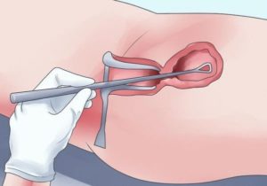Пайпель биопсия эндометрия