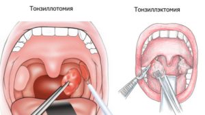 Тонкие белые прожилки на миндалинах у ребенка