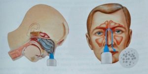 Заложенность носа после промывания