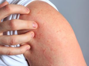 Аллергия на мильгамму