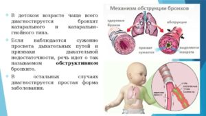 Частые Обструктивные бронхиты у ребёнка