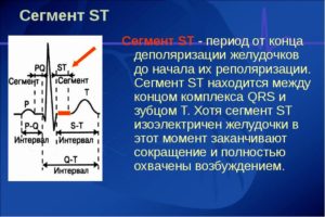 Что значит снижение сегмента ST