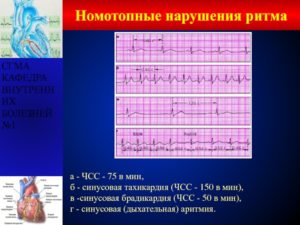 Тахикардия, пульс 150