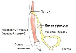 Киста урахуса операция