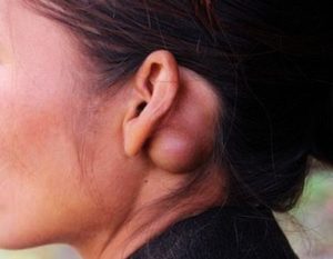 Болевой синдром за ухом возле мочки