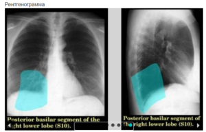 Очаг в сегменте S10 левого легкого