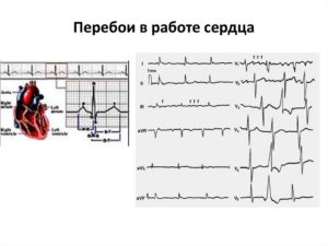 Перебои в сердце