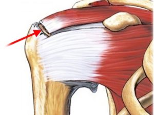 Повреждение сухожилия надостной мышцы