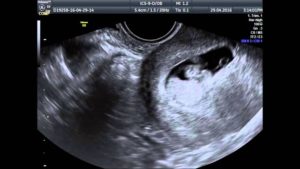 Замершая беременность 15-16 недель